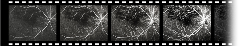 荧光素血管造影（FA）和吲哚青绿眼底血管造影（IA）的高速录影